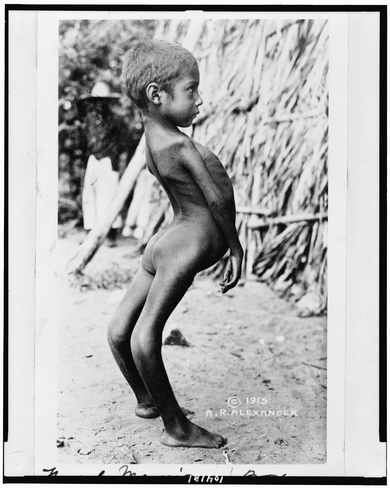 Freak Mexican boy, c1915. — historic photograph