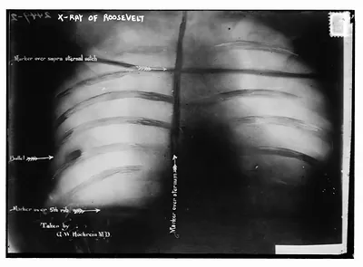 X-Ray of Roosevelt shows bullet